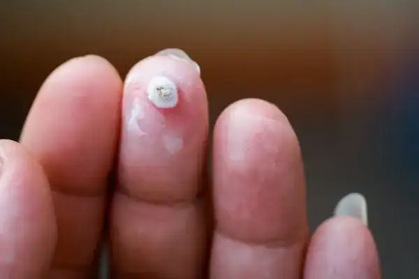 Image of white wart before cryopen treatment Melton Mowbray