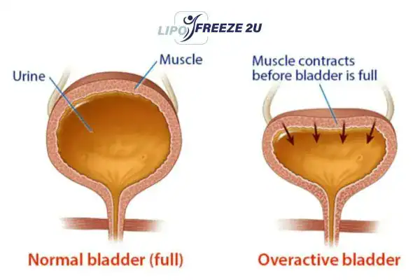 diagram of overactive bladder treatment Melton Mowbray