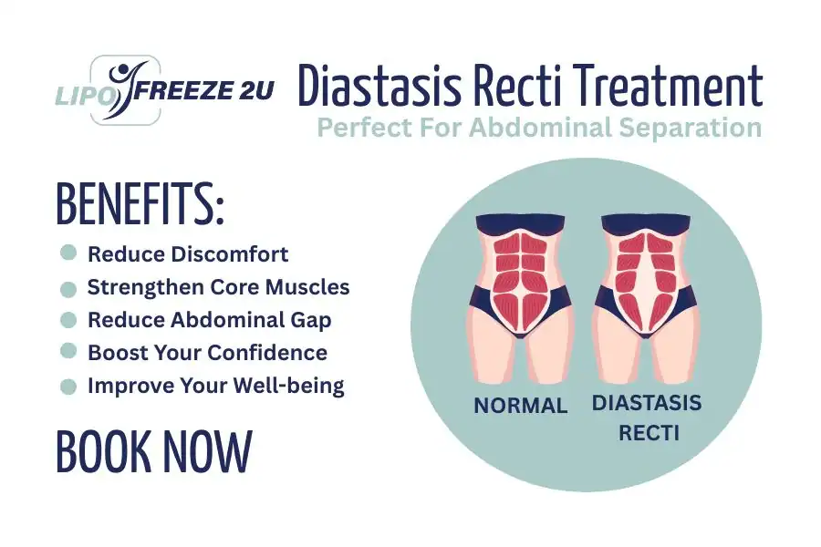 How Long Will It Take to See Improvements in Diastasis Recti Melton Mowbray