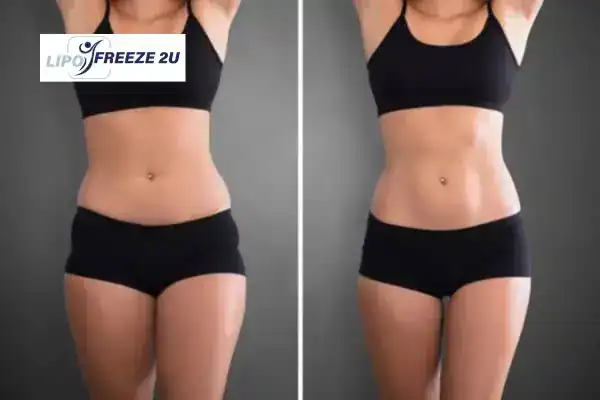 How Can LIPO FREEZE 2U Support Your Post-Pregnancy Body Recovery Melton Mowbray?