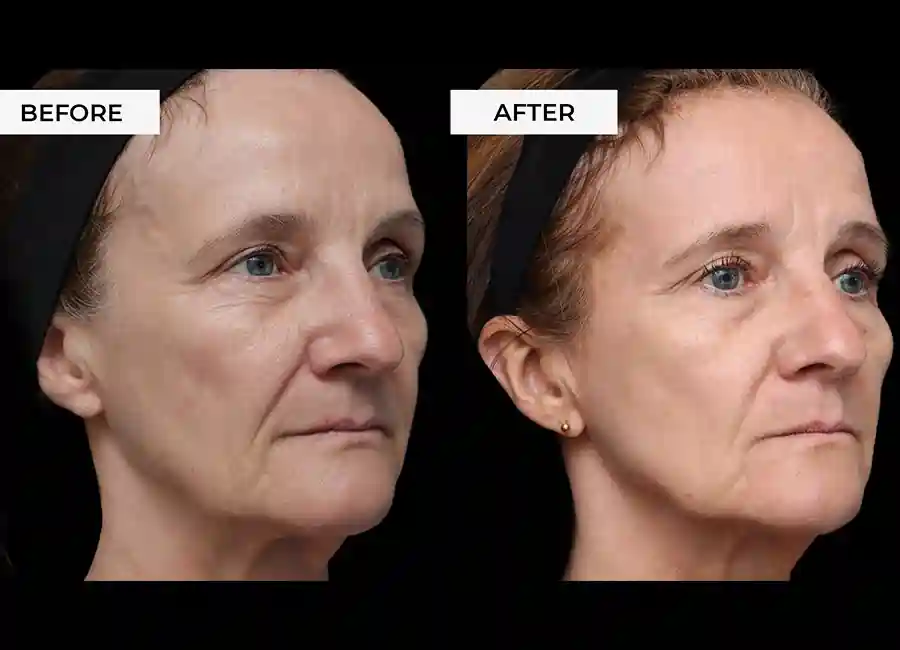 How Many RF Microneedling Sessions Will You Need to See a Difference Melton Mowbray?