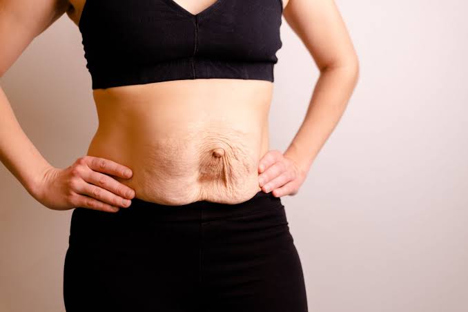 Is Surgery Really the Only Way to Repair Diastasis Recti Melton Mowbray?