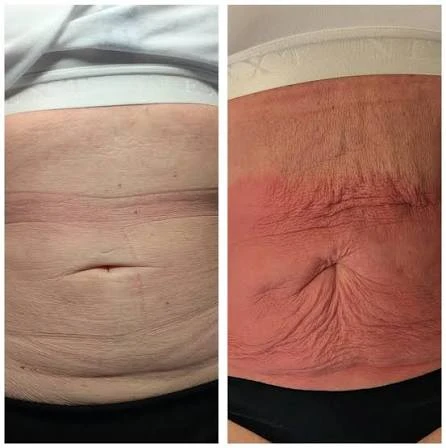 How Does RF Microneedling Improve Crepey, Thin and Uneven Skin Texture Melton Mowbray?