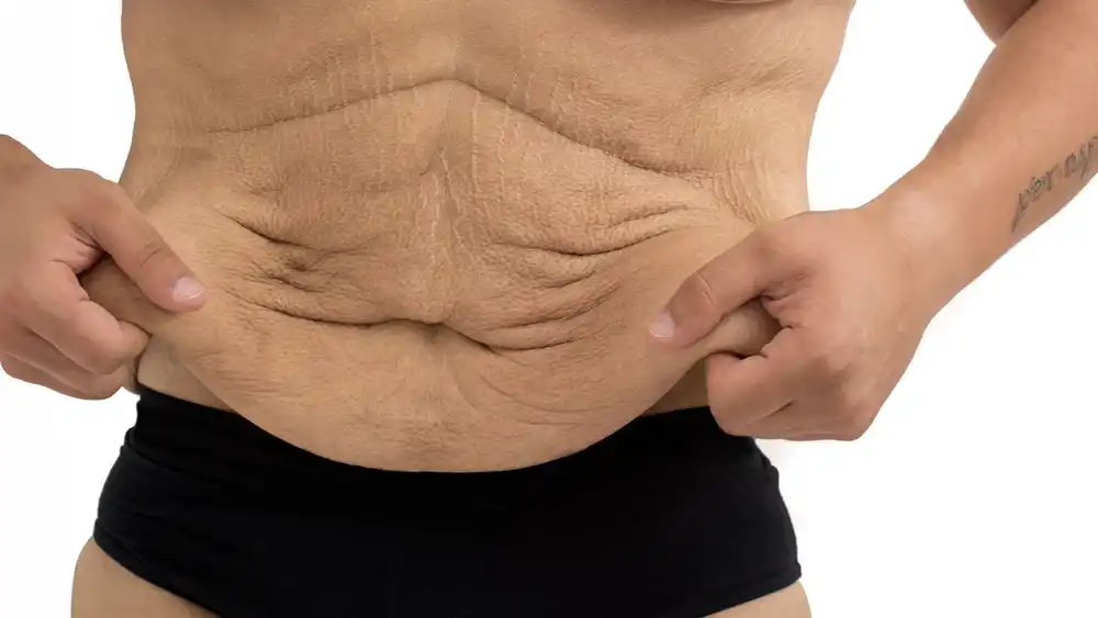 Why Does Weight Loss Medication Leave Some People With Loose or Sagging Skin Melton Mowbray?
